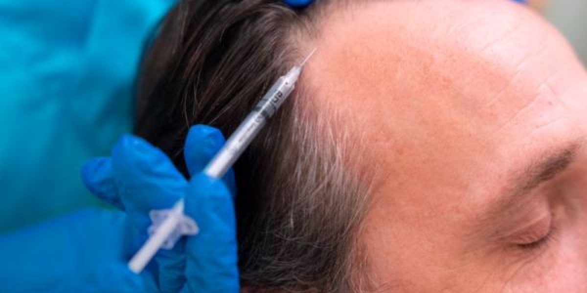 Hair Transplant in Dubai PRP Support for Hair Growth