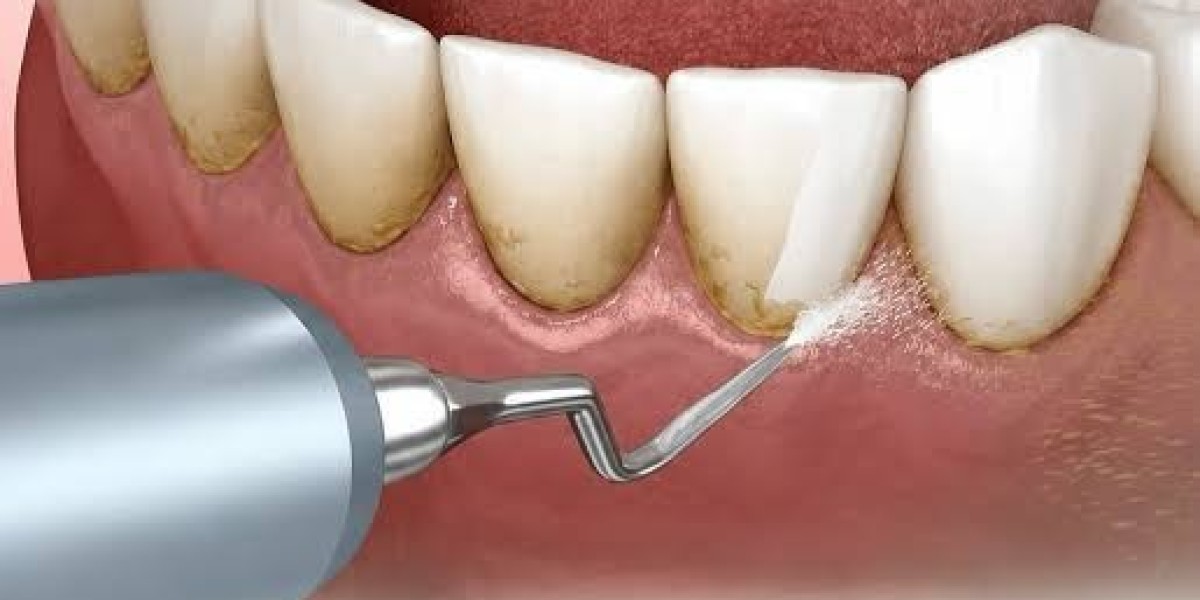 Scaling & Root Planing in Waxhaw: Deep Gum Cleaning to Treat Periodontal Disease and Restore Healthy Gums
