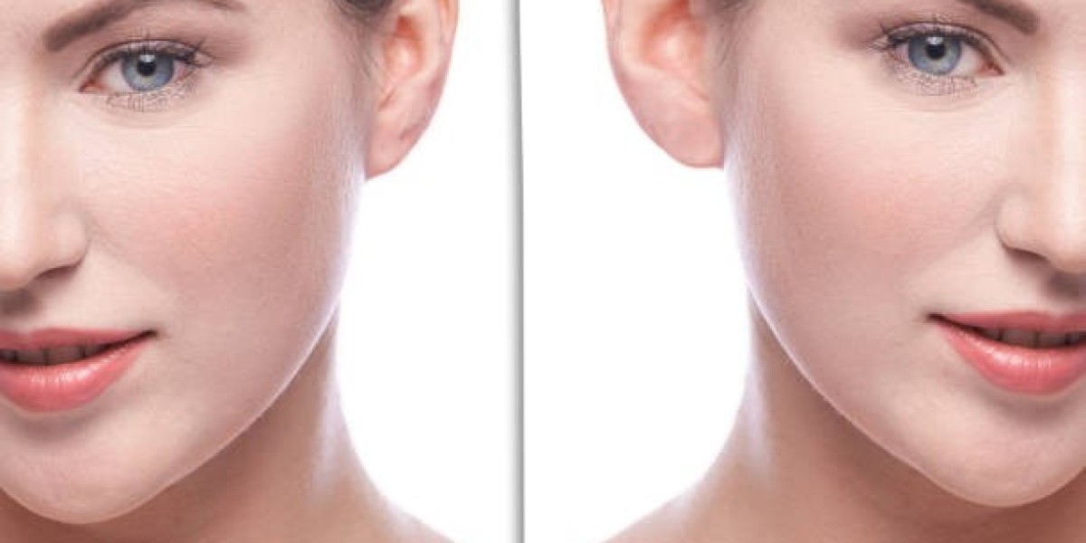 Buccal Fat Removal in Dubai: Your Complete Guide to Sculpted Cheeks