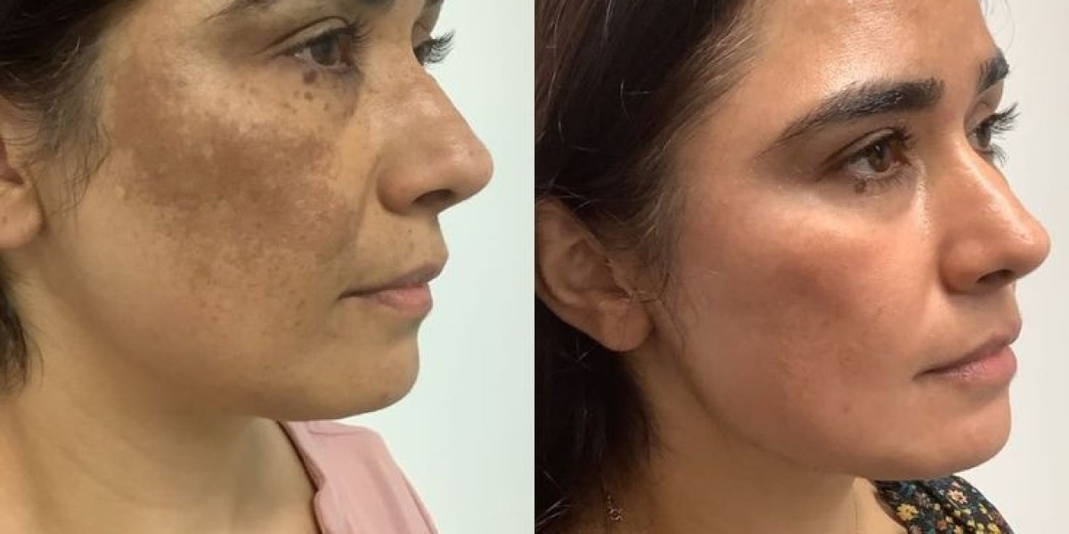 Skin Pigmentation in Dubai for Clearer, Brighter Skin