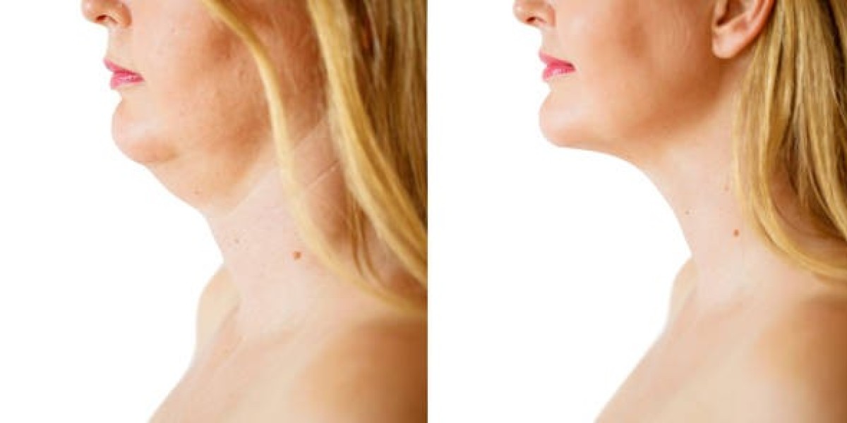 How Chin Liposuction in Dubai Creates a Sharper Jawline