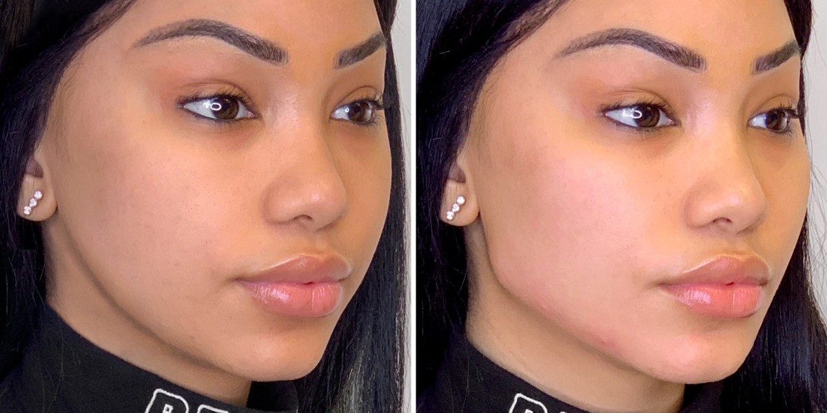 Brow Lift Surgery in Dubai for Youthful Facial Balance