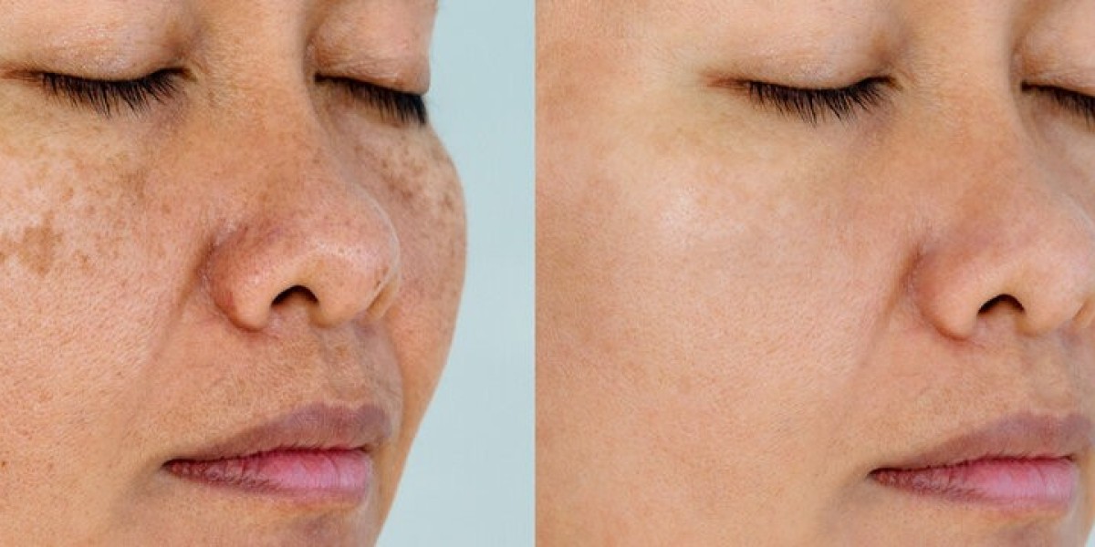 Why Skin Pigmentation Happens in Dubai Climate