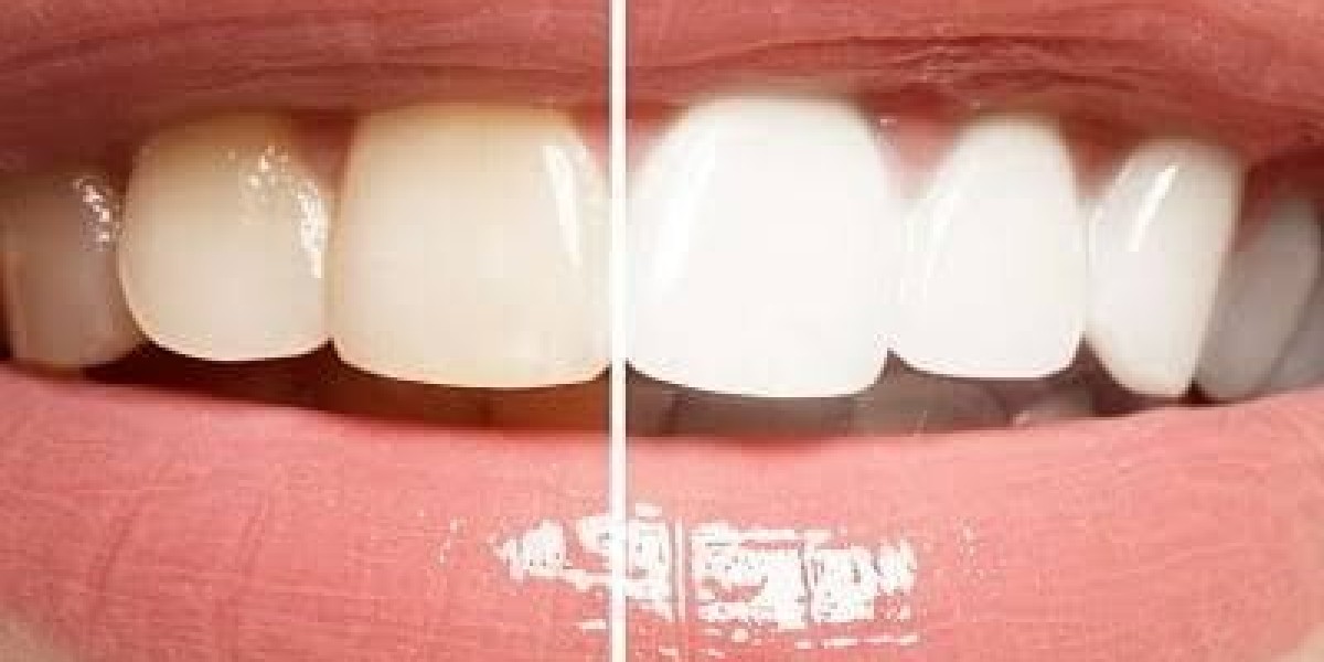 Professional Whitening for Stunning Results