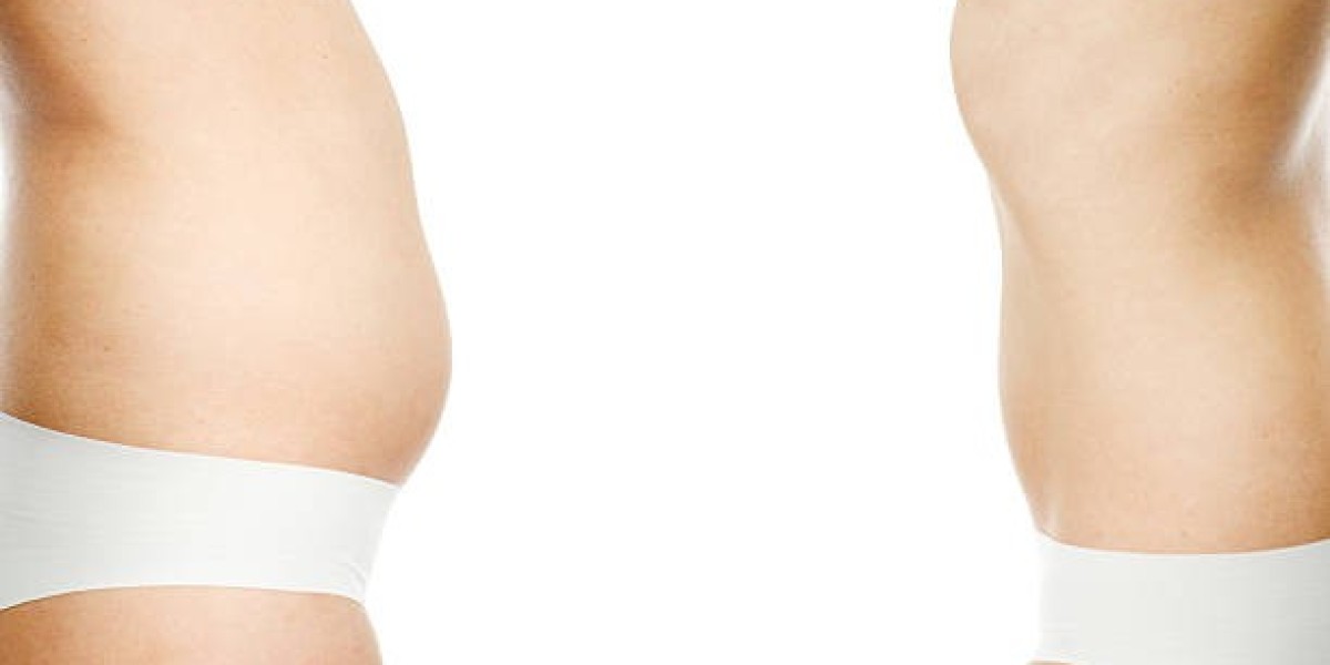 BodyTite Liposuction in Dubai: Minimally Invasive Body Sculpting