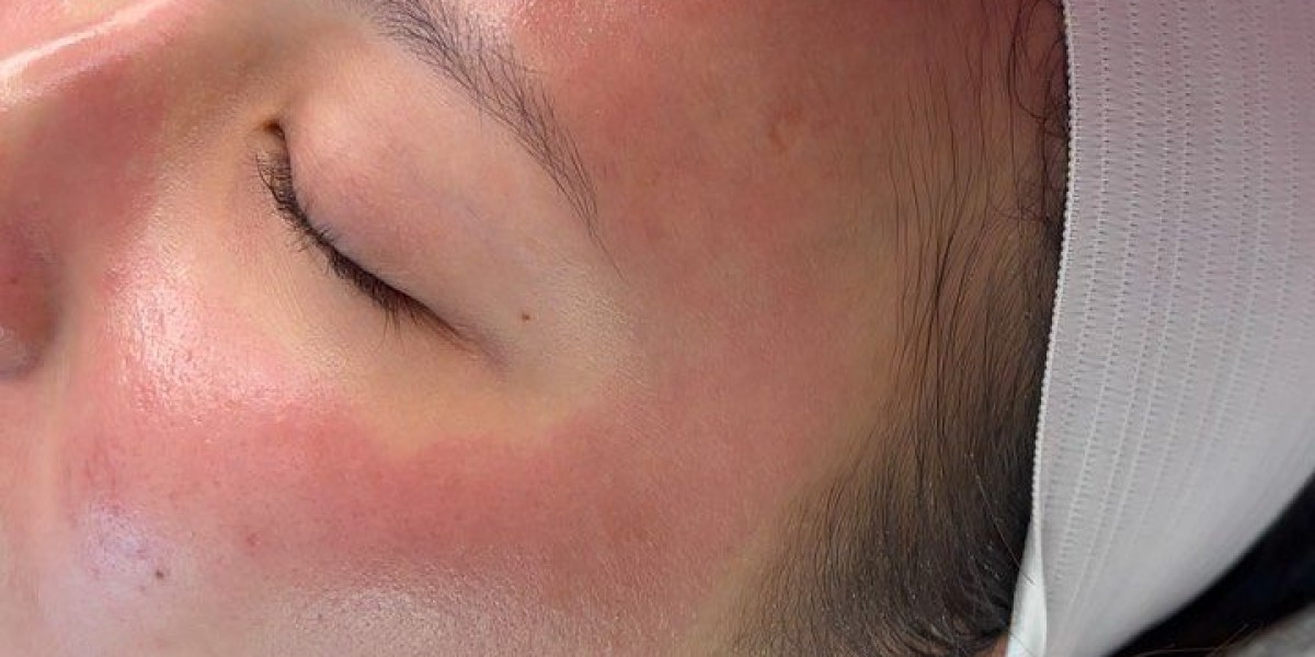 Microneedling with PRP in Dubai for Even Skin Tone