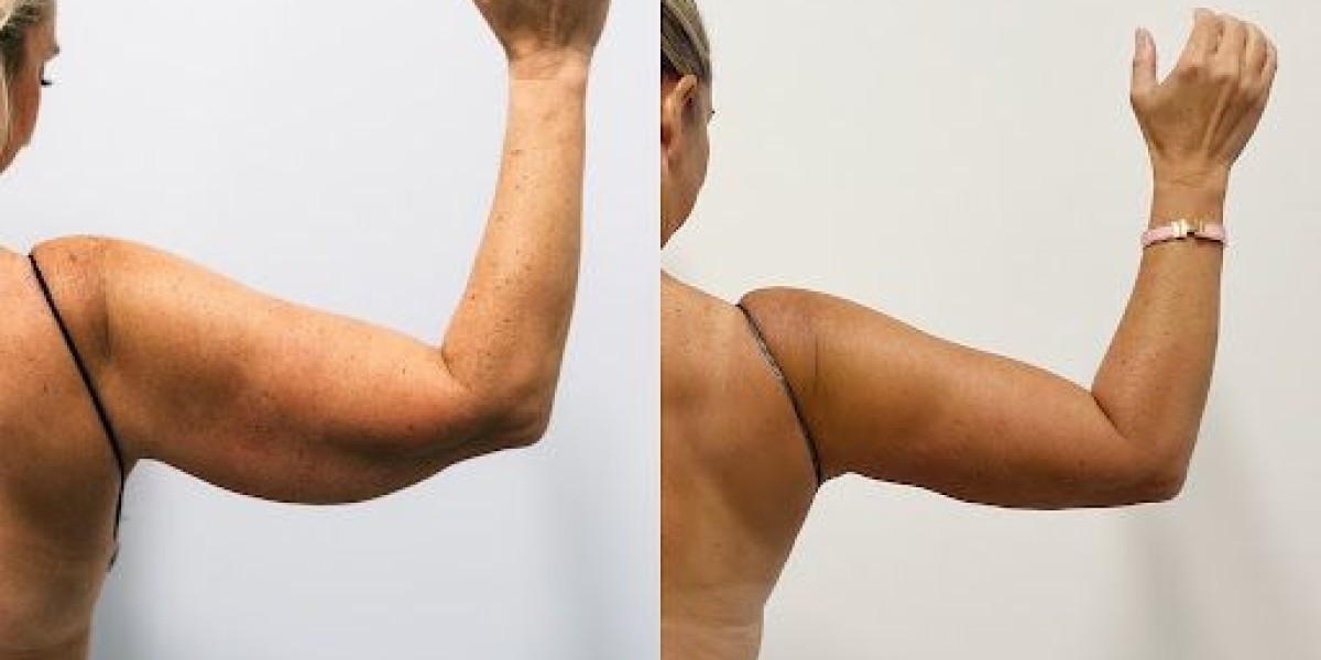 Arm Lift Surgery in Dubai: Good Candidate Guide