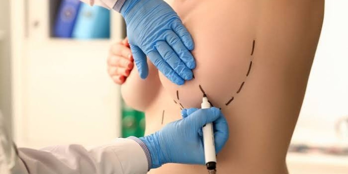 Preparing for Breast Reduction Surgery: A Step-by-Step Guide