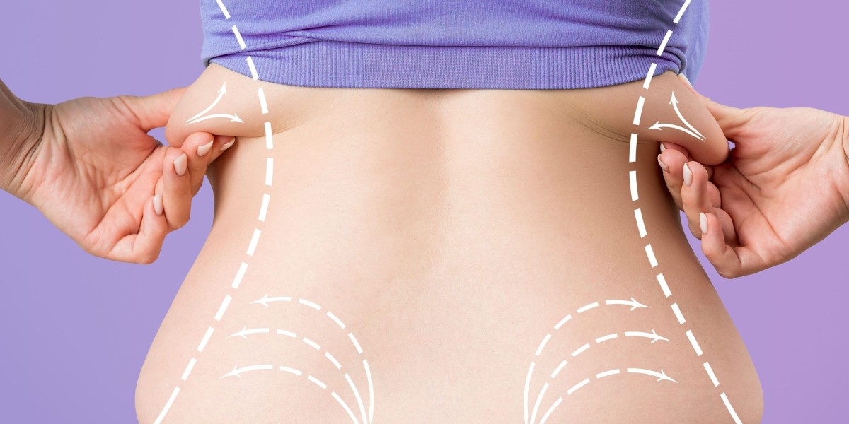 Modern Liposuction Techniques for Beautiful Results at Glam Clinic Islamabad