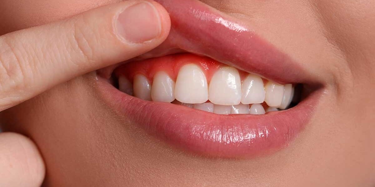 Understanding the Causes and Treatment of Gum Recession