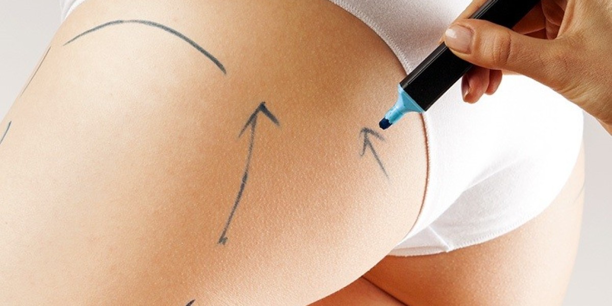 Why Localized Fat Can Resist Even Strict Fitness Plans
