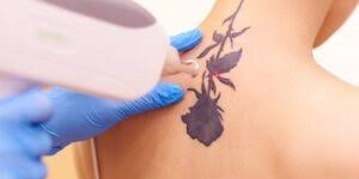 Laser Tattoo Removal in Riyadh for Brighter and More Even Skin