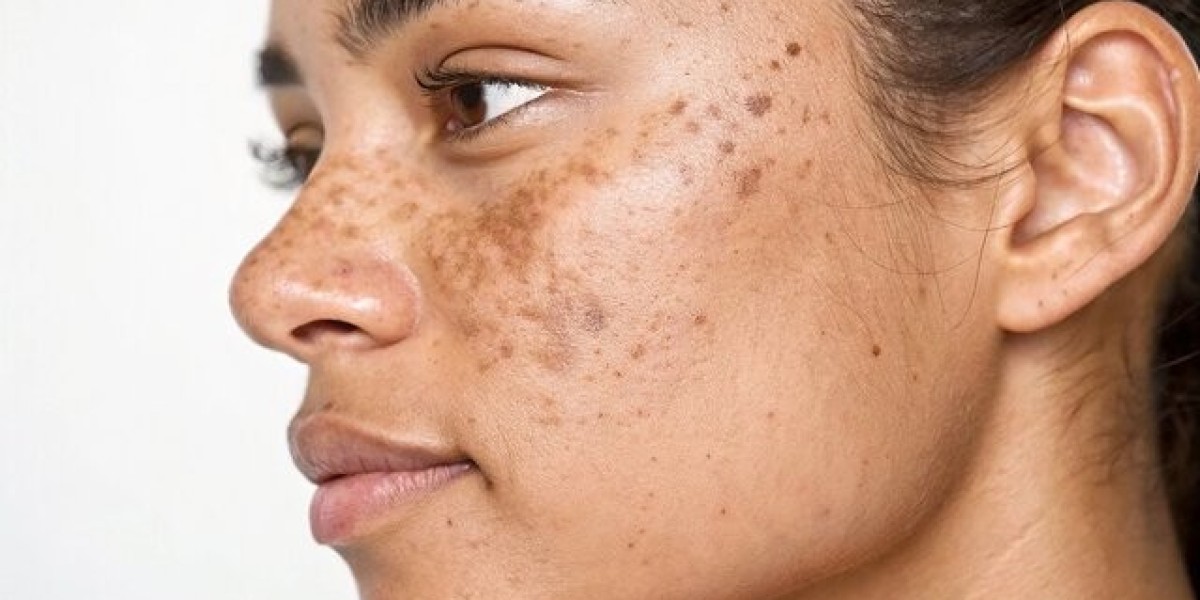 Dark Spots Correction in Chevy Chase, MD | Spa Chevy Chase