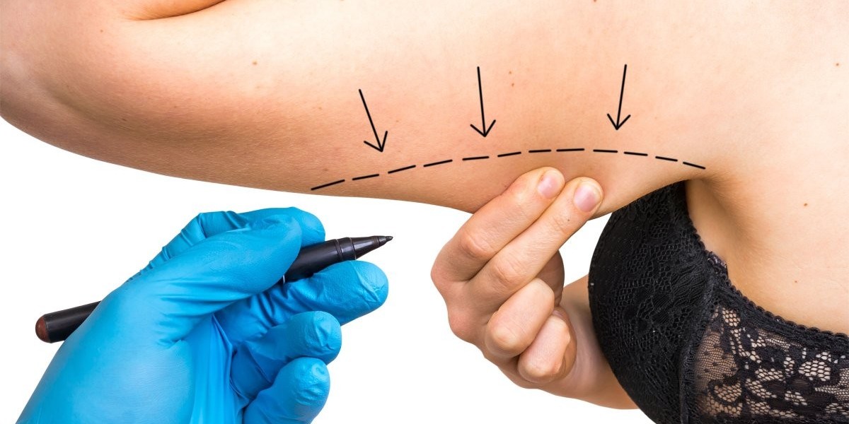Arm Lift Surgery in Dubai: Questions to Ask First