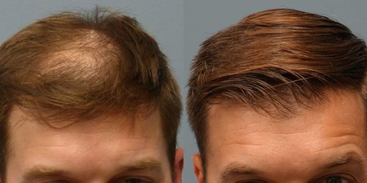 Hair Transplant in Dubai: A Practical Guide to Modern Hair Restoration
