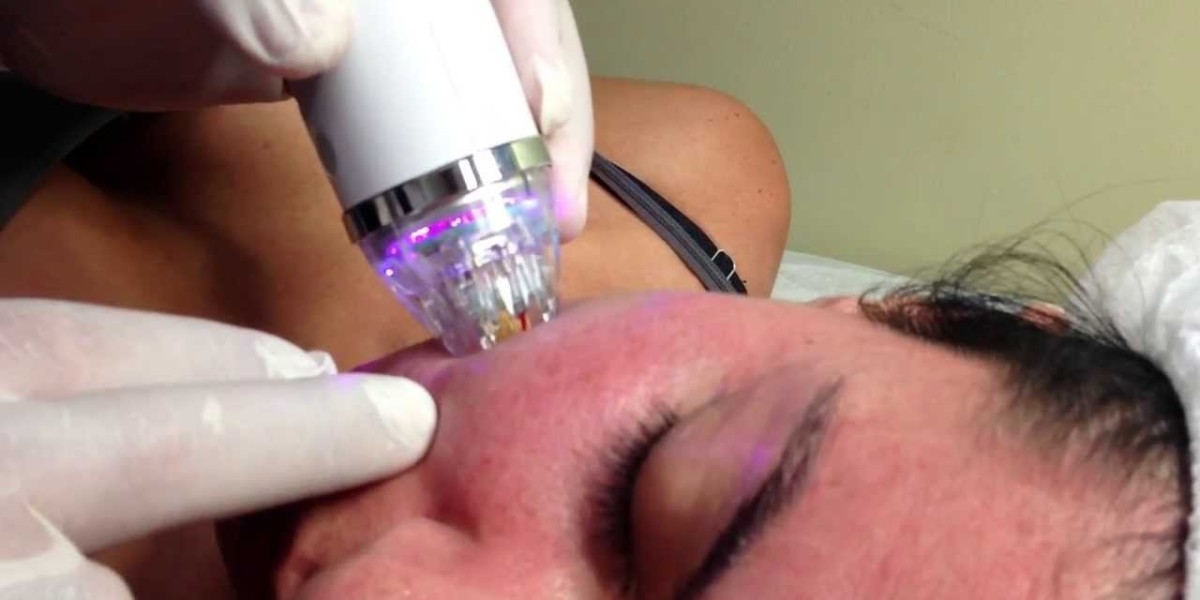 Fractional RF Microneedling in Dubai for Wrinkles