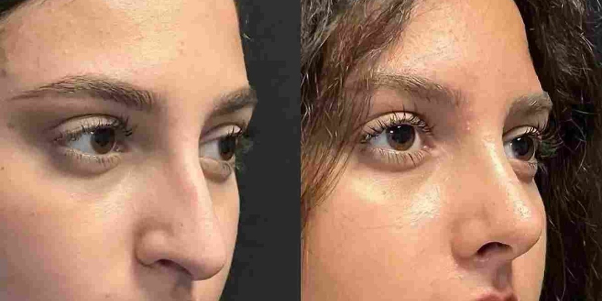 Rhinoplasty in Dubai: How Facial Harmony Is Achieved