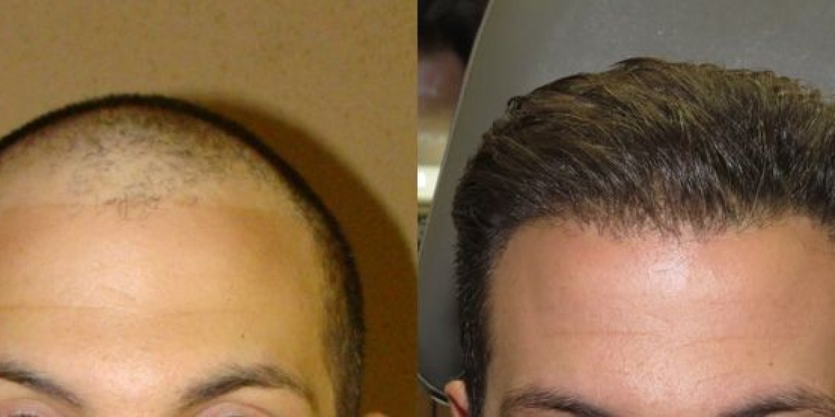 Hair Transplant in Dubai: Your Complete Guide to Natural and Lasting Hair Restoration