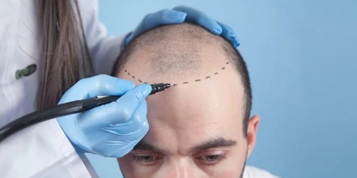 The Ultimate Guide to Hair Transplant in Istanbul Turkey