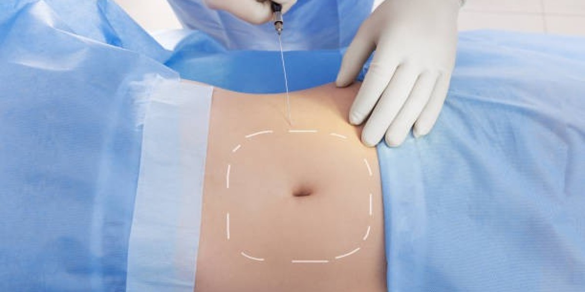 Liposuction Surgery in Dubai: Your Path to a New Shape