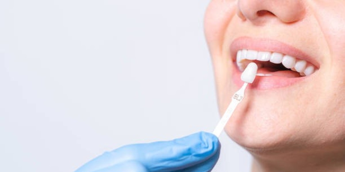 The Lifespan of Porcelain Veneers Brisbane Explained