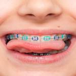 Dental Implants: Procedure, Cost