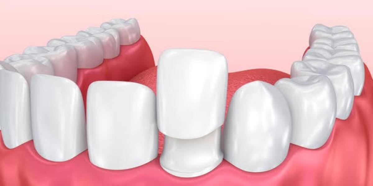 The Beauty of Non-Prep Veneers in Islamabad