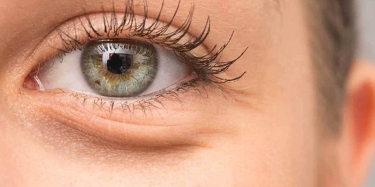 Lower Blepharoplasty in London for Under-Eye Bags