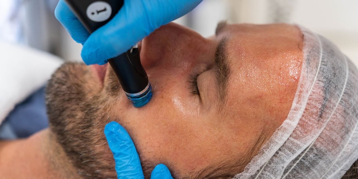 Ultertherapy Treatment in Dubai for Fine Lines