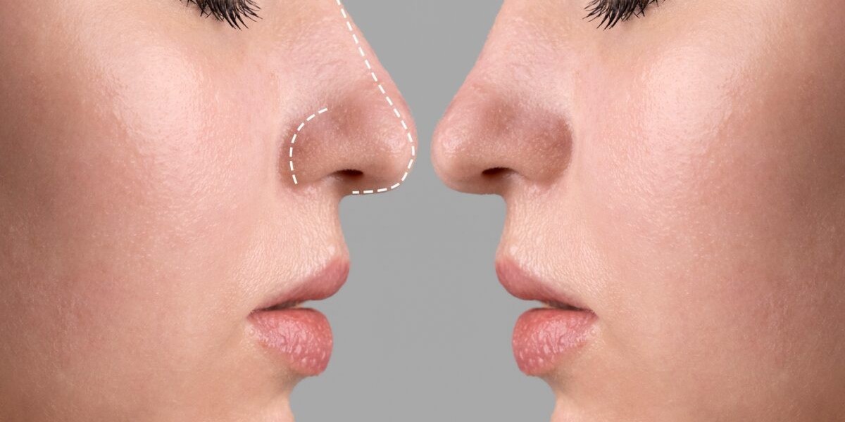 لماذا تختار تجميل الأنف في الرياض