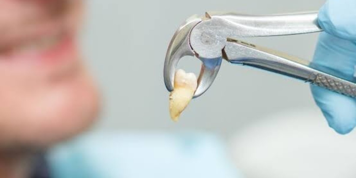 Tooth Extractions in Folsom: Safe and Gentle Tooth Removal Solutions to Relieve Pain