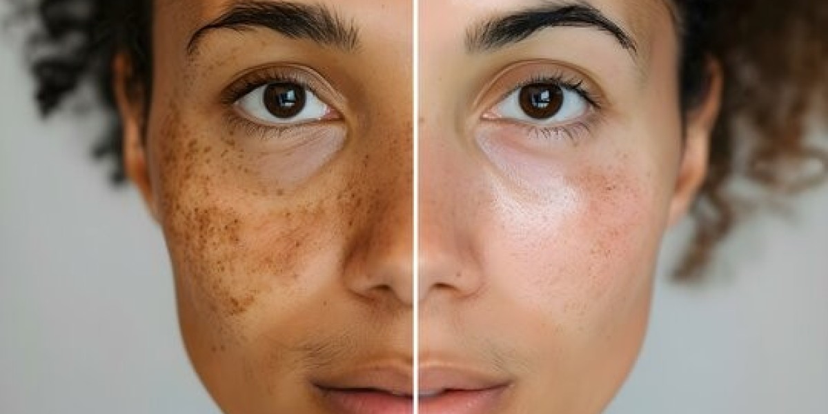 Skin Pigmentation in Dubai: Tips for Healthy Skin