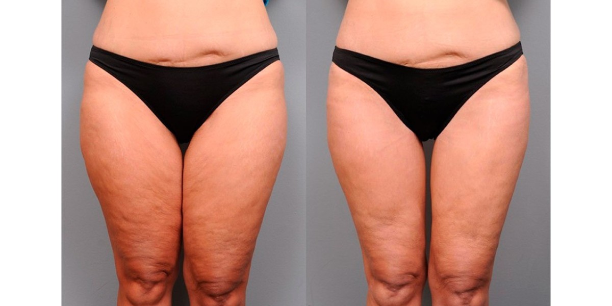 Thigh Lift in Dubai for Smoother Leg Contours