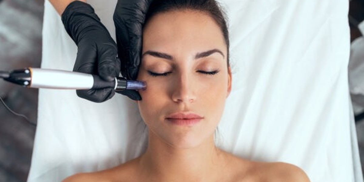 Microneedling with PRP in Dubai for Hair Growth