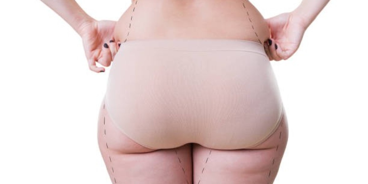 Why More People Choose Liposuction in Riyadh for Body Enhancement