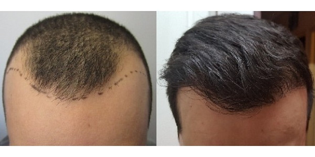 Hair Transplant in Dubai for Treating Hair Thinning