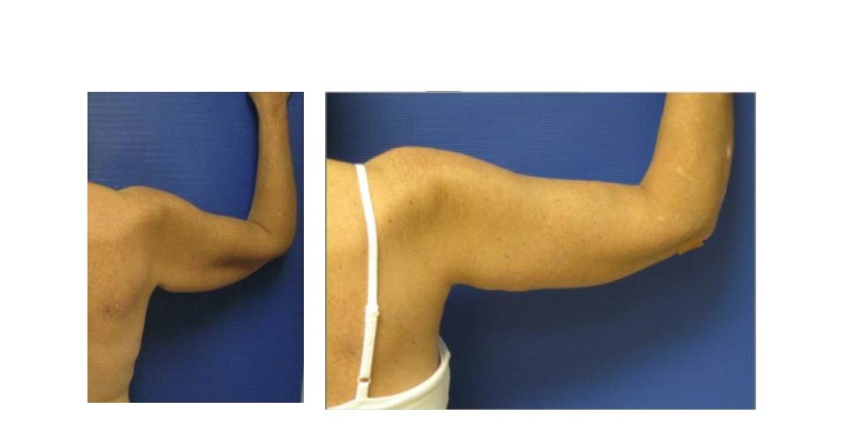 Why Choose Arm Lift Surgery in Dubai Today