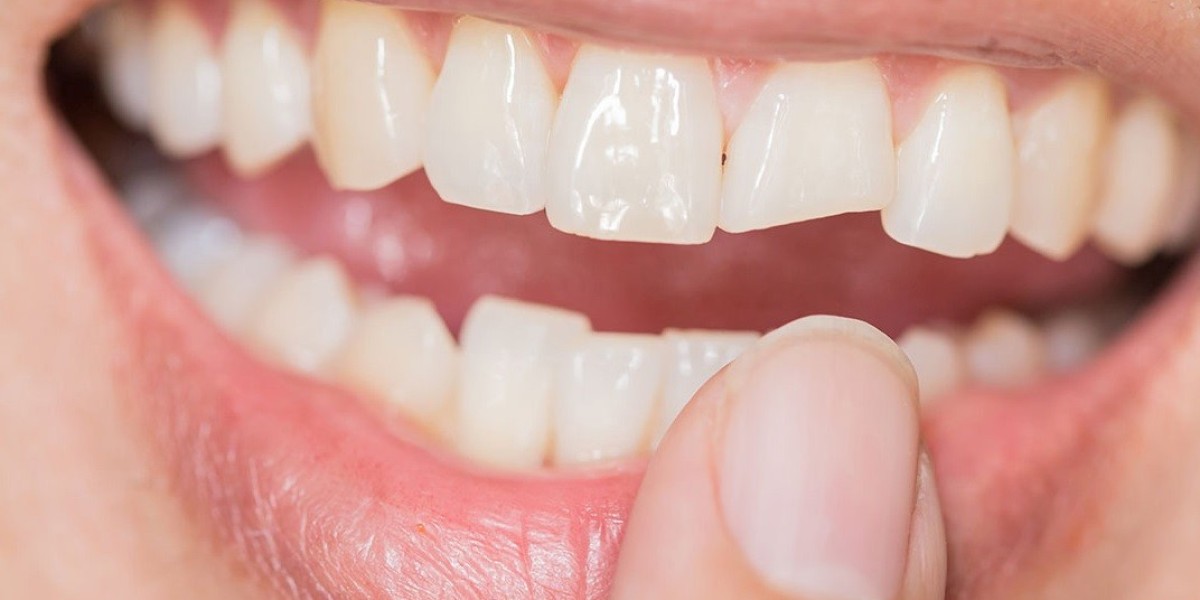 Fractured Teeth Treatment for a Stronger Smile