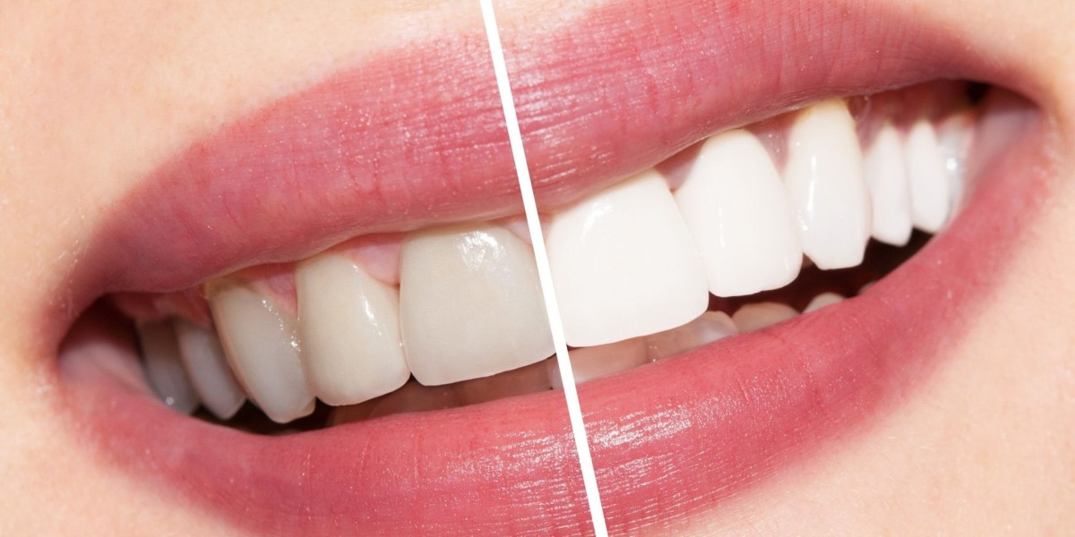 Can yellow teeth go white again?