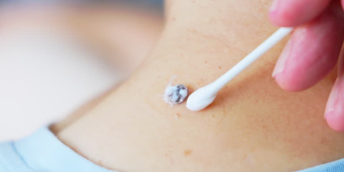 How Skin Tag Removal in Dubai Removes Unwanted Growths